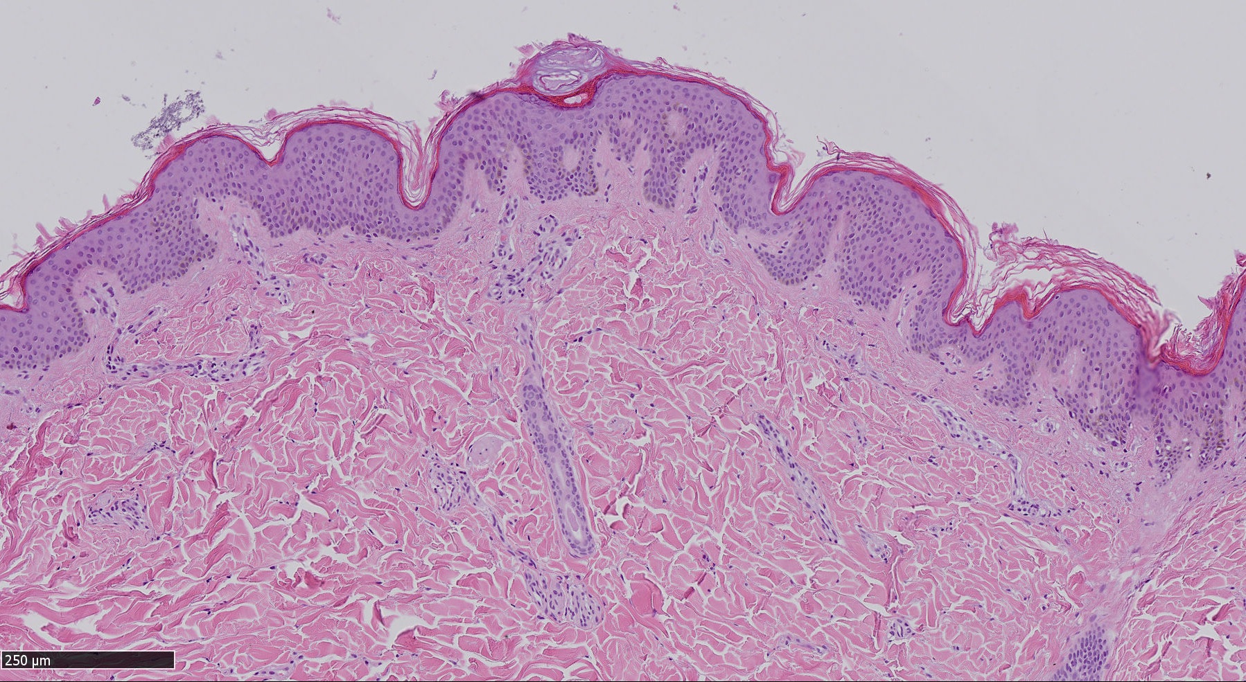 melanoma — AOU SASSARI – Melanoma maligno, l’Aou attiva un percorso terapeutico